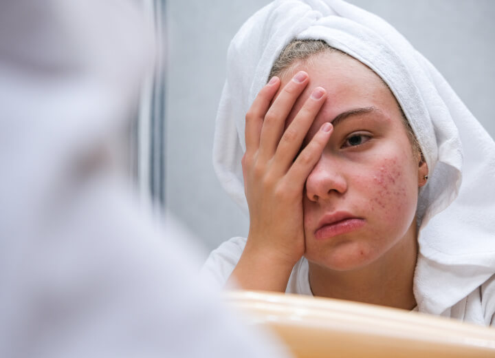 Comment se débarasser de l'acné hormonale ?